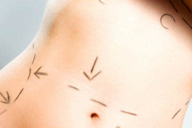 Abdominoplastia (Reducción de abdomen)